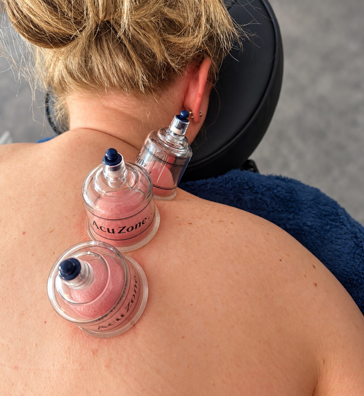 Cupping treatment applied to the upper back during an individualized physical therapy visit
