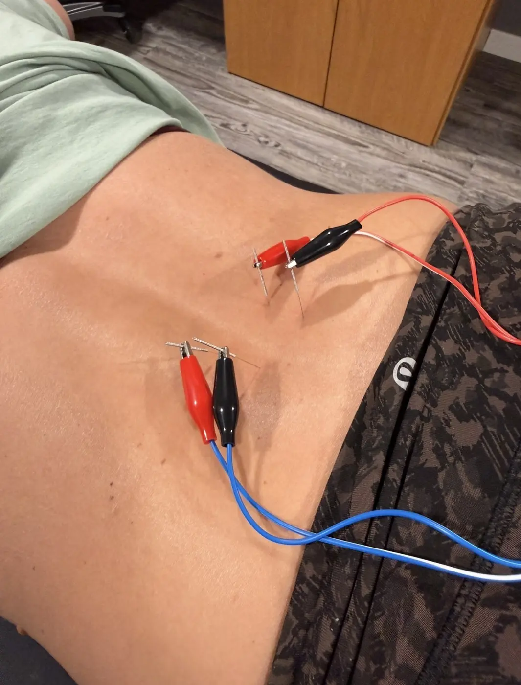 Dry needling with electrical stimulation during an individualized physical therapy visit